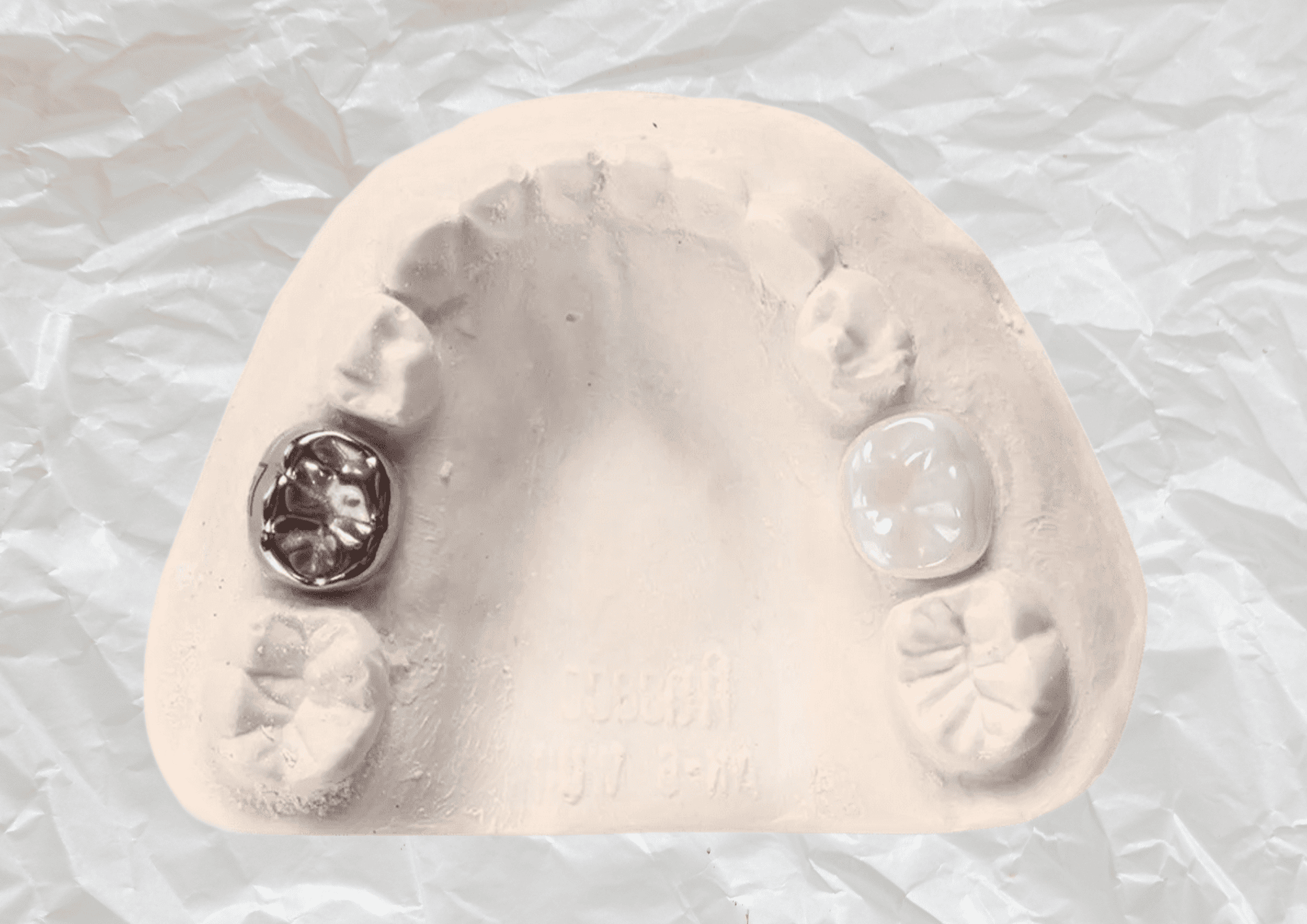 Защита молочных зубов: когда детям необходимо устанавливать коронки?